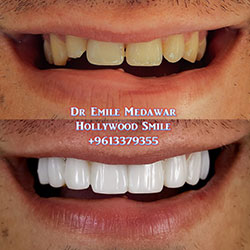 Composite Veneers Lebanon
