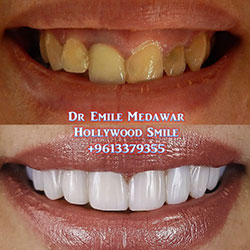Composite Veneers Lebanon