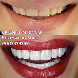 Composite Veneers Lebanon