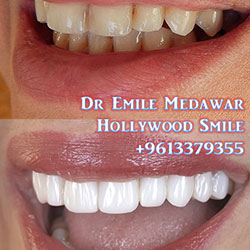Composite Veneers Lebanon