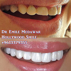 Composite Veneers Lebanon