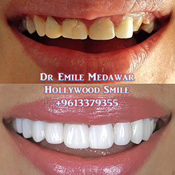 Composite Veneers Lebanon