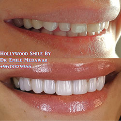 Composite Veneers Lebanon