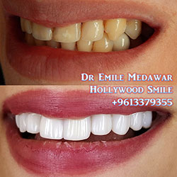 Composite Veneers Lebanon