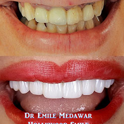 Composite Veneers Lebanon