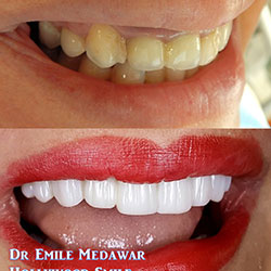 Composite Veneers Lebanon