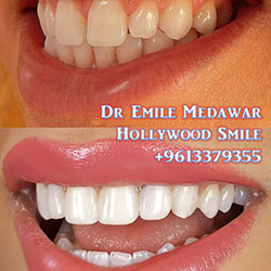 Composite Veneers Lebanon