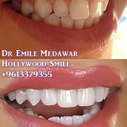 Composite Veneers Lebanon
