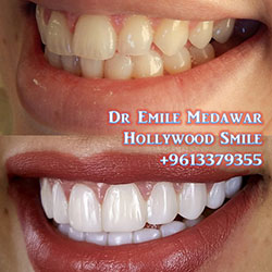Composite Veneers Lebanon
