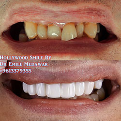 Composite Veneers Lebanon