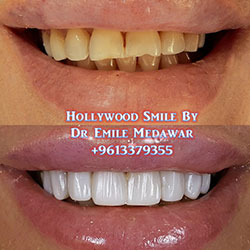 Composite Veneers Lebanon