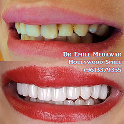Composite Veneers Lebanon