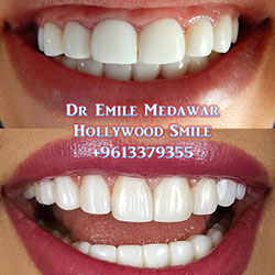 Composite Veneers Lebanon