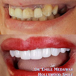 Composite Veneers Lebanon