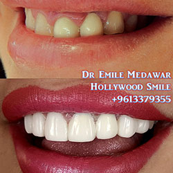 Composite Veneers Lebanon