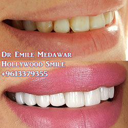 Composite Veneers Lebanon