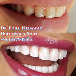 Composite Veneers Lebanon
