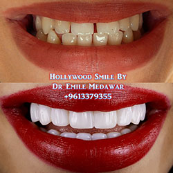 Composite Veneers Lebanon