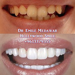 Composite Veneers Lebanon