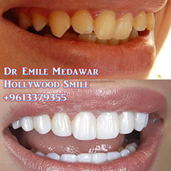 Composite Veneers Lebanon