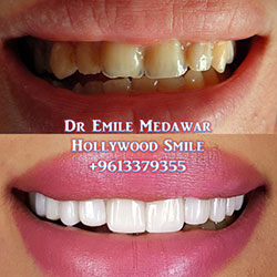 Composite Veneers Lebanon