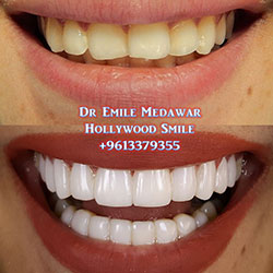 Composite Veneers Lebanon