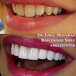 Composite Veneers Lebanon