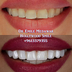 Composite Veneers Lebanon