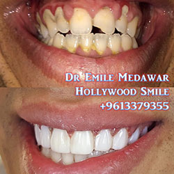 Composite Veneers Lebanon