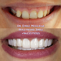 Composite Veneers Lebanon