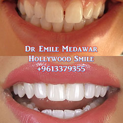 Composite Veneers Lebanon
