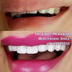 Composite Veneers Lebanon