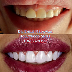 Composite Veneers Lebanon
