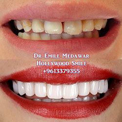 Composite Veneers Lebanon