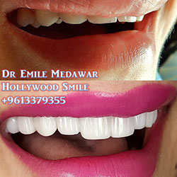 Composite Veneers Lebanon