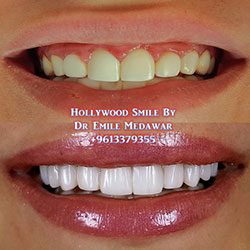 Composite Veneers Lebanon