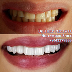 Composite Veneers Lebanon