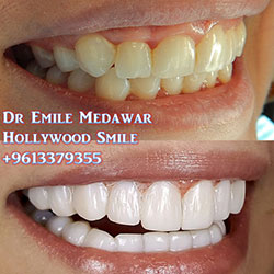 Composite Veneers Lebanon