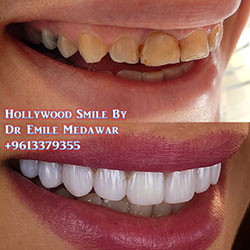 Composite Veneers Lebanon