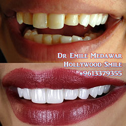 Composite Veneers Lebanon