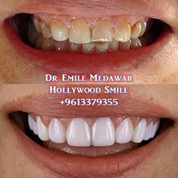 Composite Veneers Lebanon