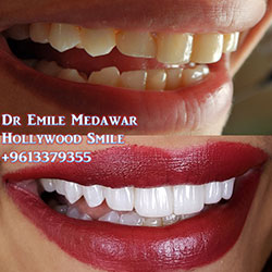 Composite Veneers Lebanon