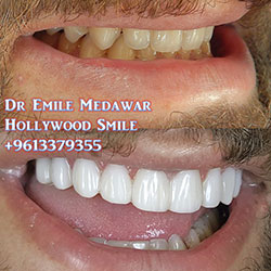 Composite Veneers Lebanon