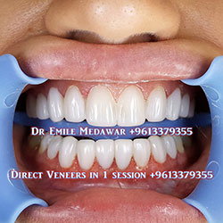Composite Veneers Lebanon