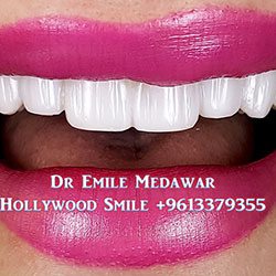 Composite Veneers Lebanon