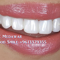 Composite Veneers Lebanon