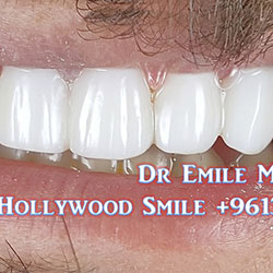 Composite Veneers Lebanon