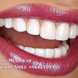 Composite Veneers Lebanon