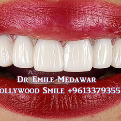 Composite Veneers Lebanon