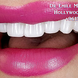 Composite Veneers Lebanon